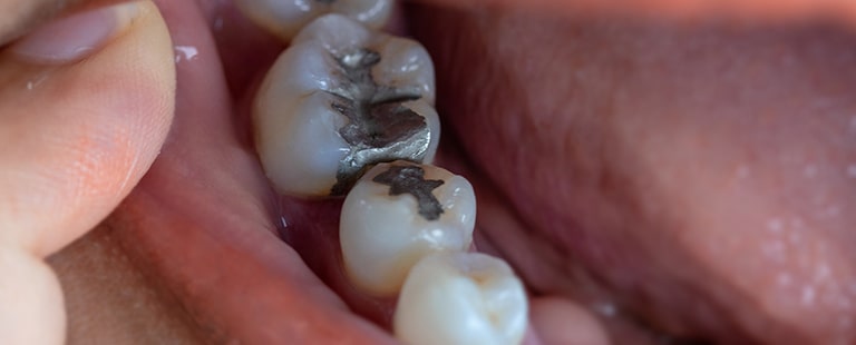 Mckennell Dental Practice Tooth Coloured Fillings